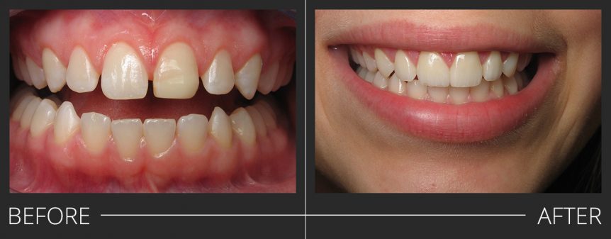 #7,8,10 Veneers #9 E.Max Crown