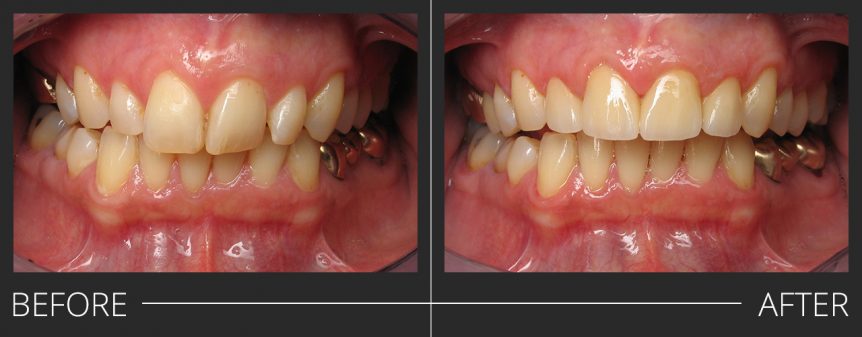 #7-10 E.Max Crowns