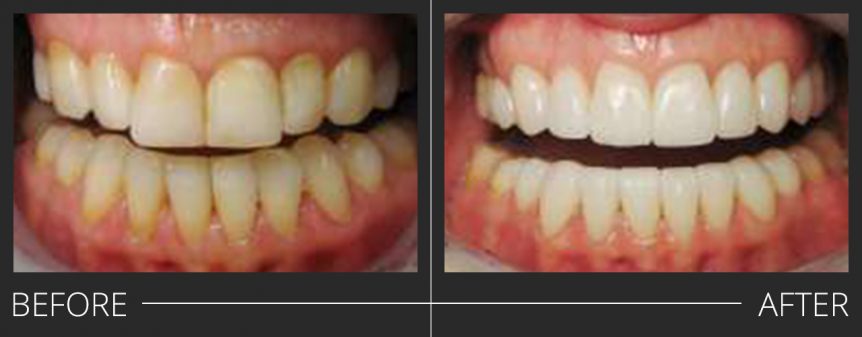 #5-12 E.Max Crowns #21-28 E.Max Veneers