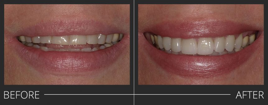 #6-11 E.Max Veneers