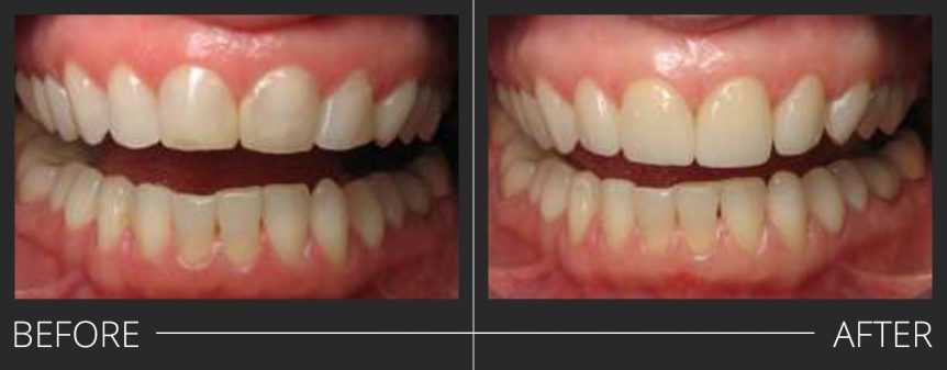 #7-10 E.Max Veneers