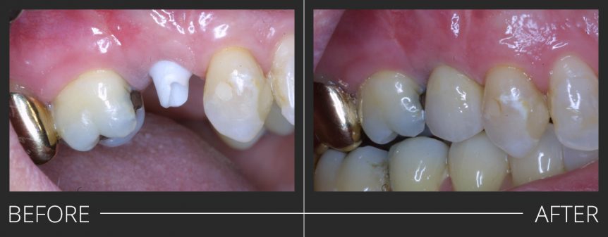 Dental Implant