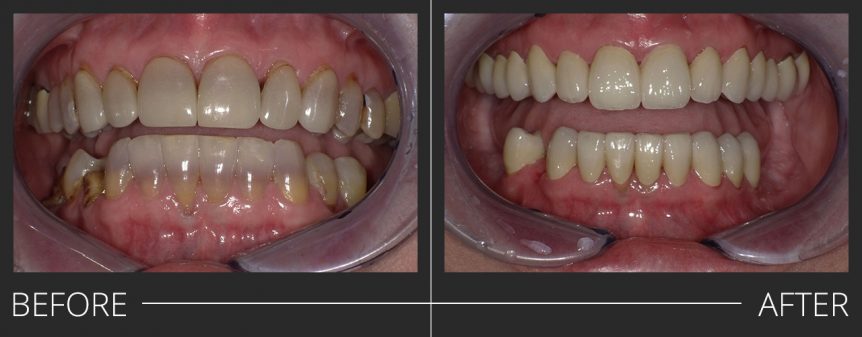 PFZ Crowns Full Mouth Reconstruction